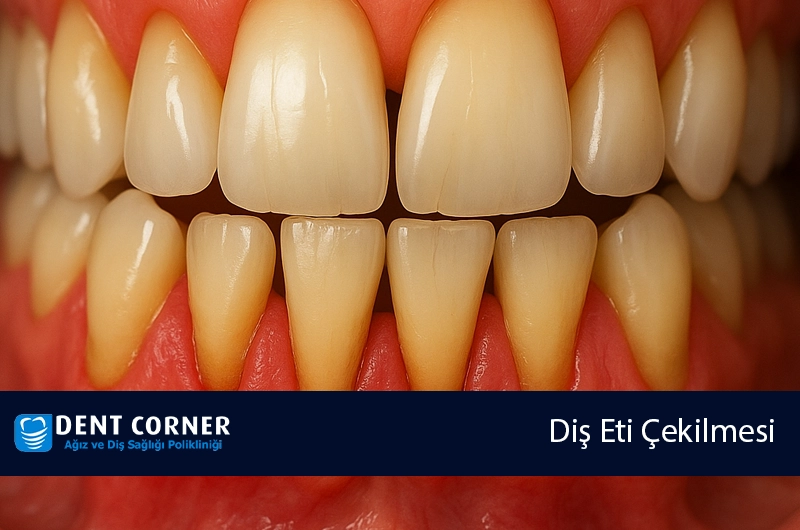 Diş eti çekilme tedavisi nasıl yapılır ?