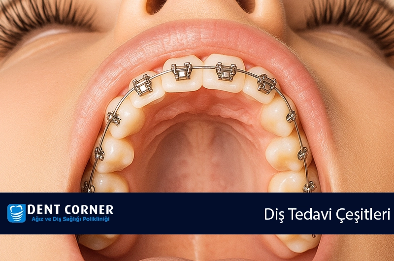 Diş Tedavi Çeşitleri