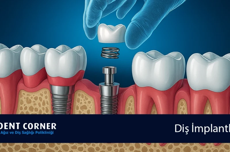 Diş İmplantı için Hangi Doktora Gitmeliyim?