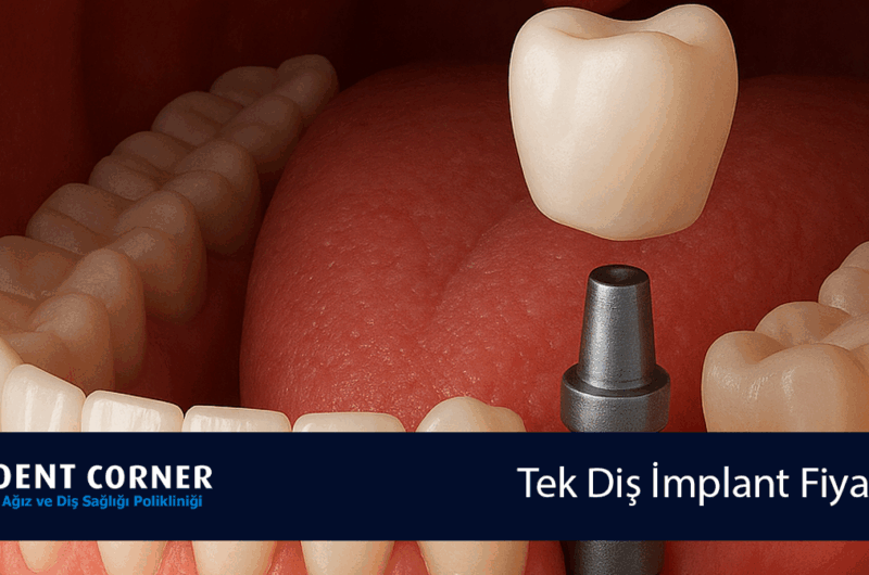 Tek Diş İmplant Fiyatları