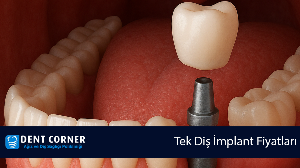 Tek Diş İmplant Fiyatları