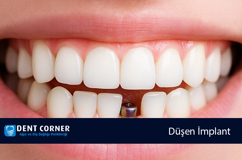 DÜŞEN İMPLANT TEKRAR YERİNE TAKILIR MI?
