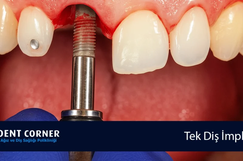 Doktor Dişimi Çekti, Yeri Boş Kaldı Ne Yapmalıyım?