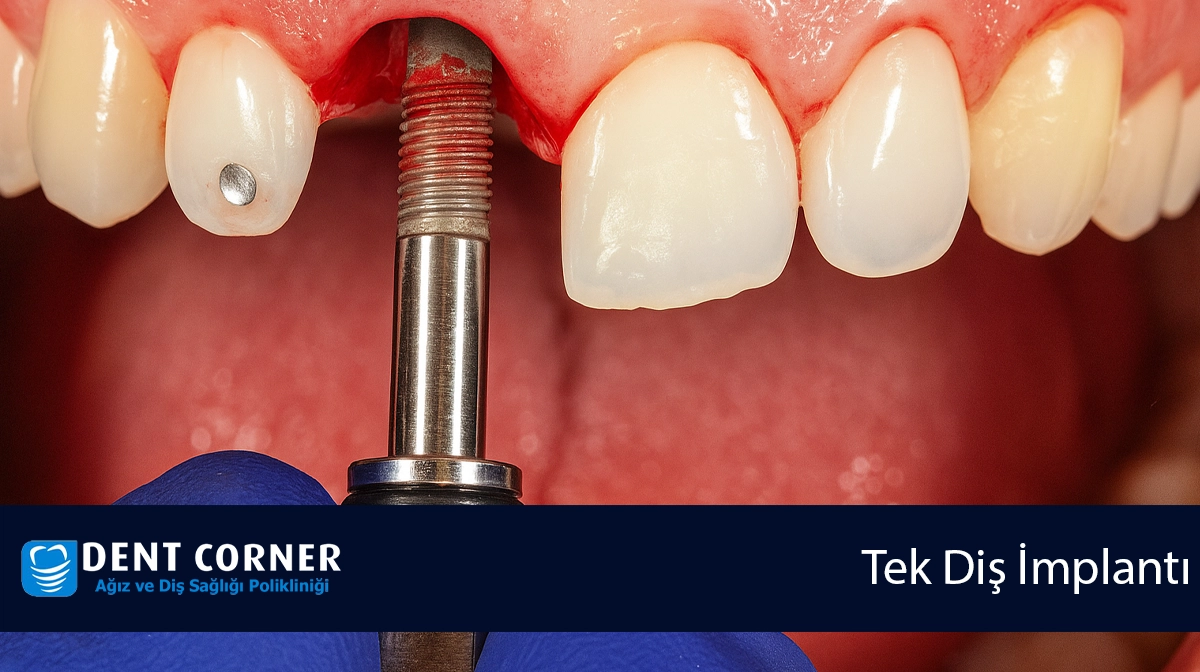 Doktor Dişimi Çekti, Yeri Boş Kaldı Ne Yapmalıyım?