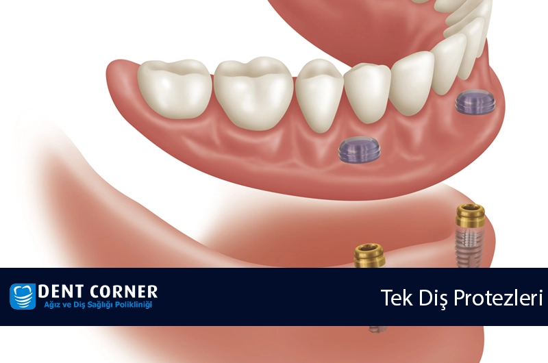 Tam Diş Protezleri Tedavi Süresi Ne Kadar Sürer?