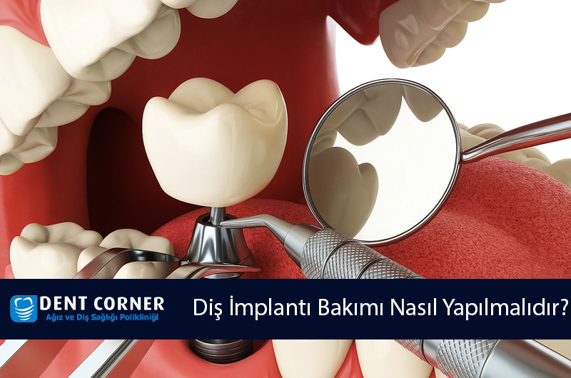 Diş İmplantı Bakımı Nasıl Yapılmalıdır?