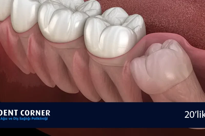 20 Yaş Dişlerini Çektirmeli Miyiz?
