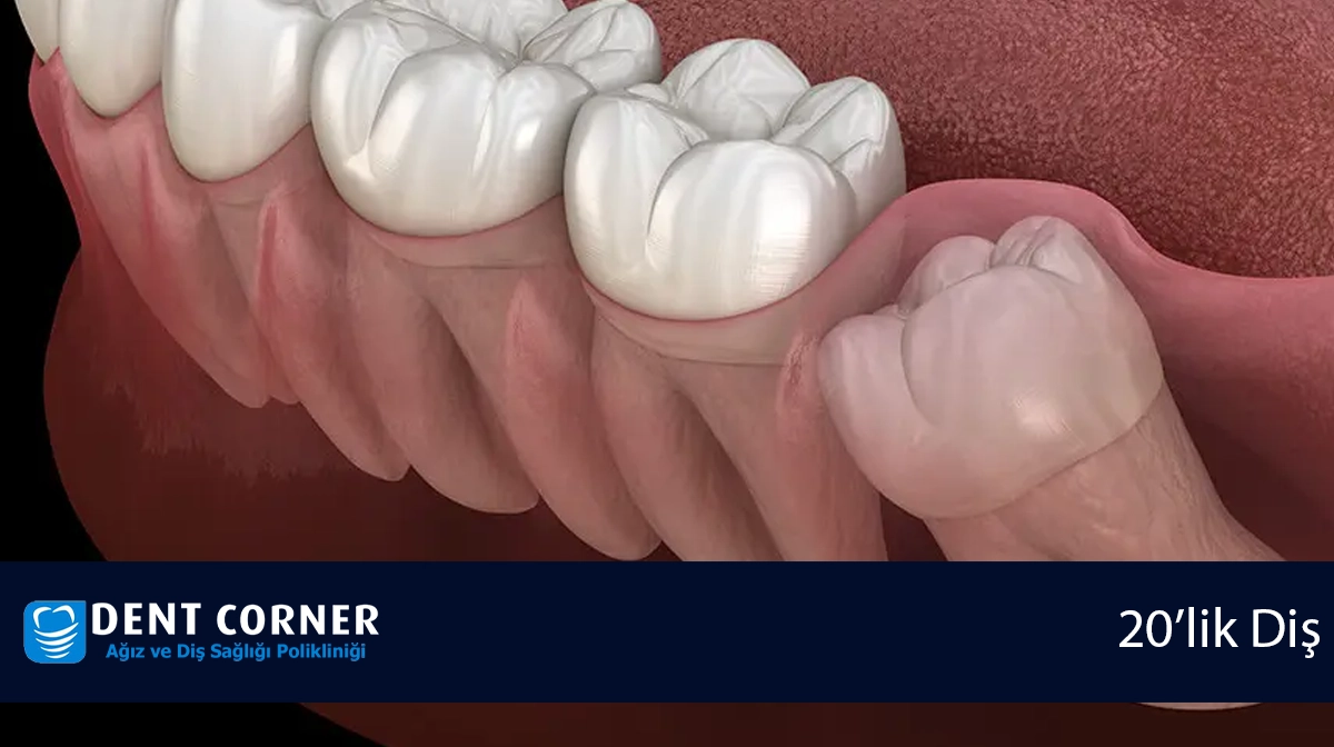 20 Yaş Dişlerini Çektirmeli Miyiz?