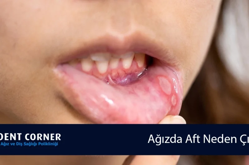 Aft Nedir? Aft Neden Olur ve Nasıl Geçer?