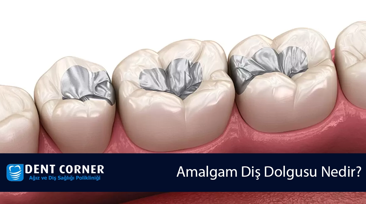 Amalgam Diş Dolgusu Nedir? Neden Sökümü Tavsiye Edilir?