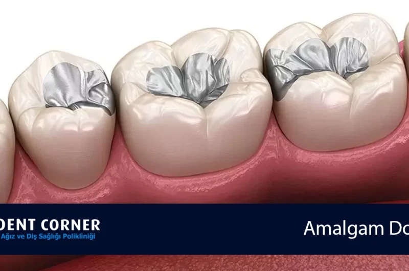 Amalgam Dolgu Sökümü