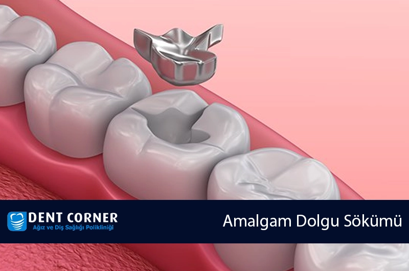 Amalgam Dolgu Sökümü