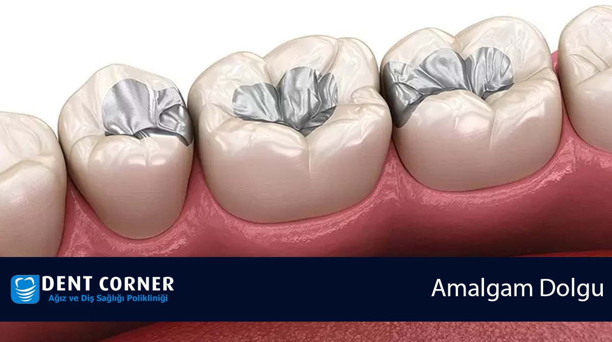 Amalgam Dolgu Sökümü