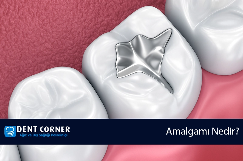 Diş Amalgamı Nedir? Riskleri ve Bergen Amalgam Çalışması