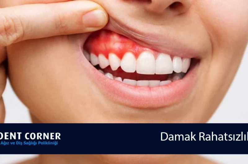 Damak Rahatsızlıkları Nelerdir? Sebepleri ve Çözümleri Nelerdir?