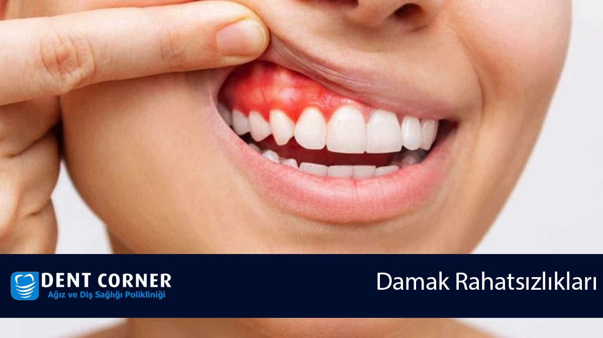 Damak Rahatsızlıkları Nelerdir? Sebepleri ve Çözümleri Nelerdir?