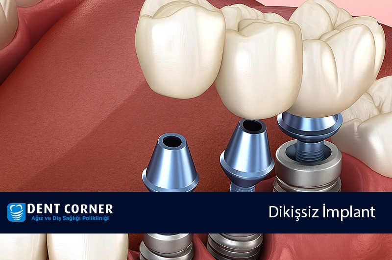 Dikişsiz İmplant – Eksik Diş Tedavisi
