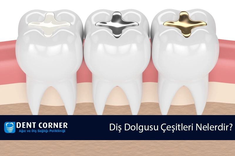 Diş Dolgusu Çeşitleri Nelerdir?