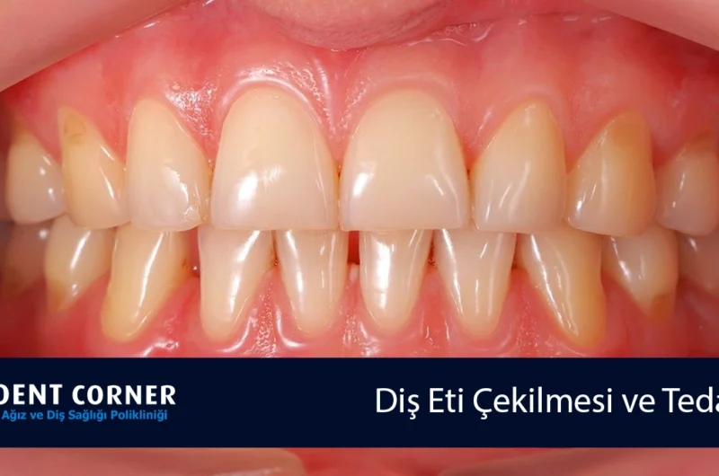 Diş Eti Çekilmesi ve Tedavisi
