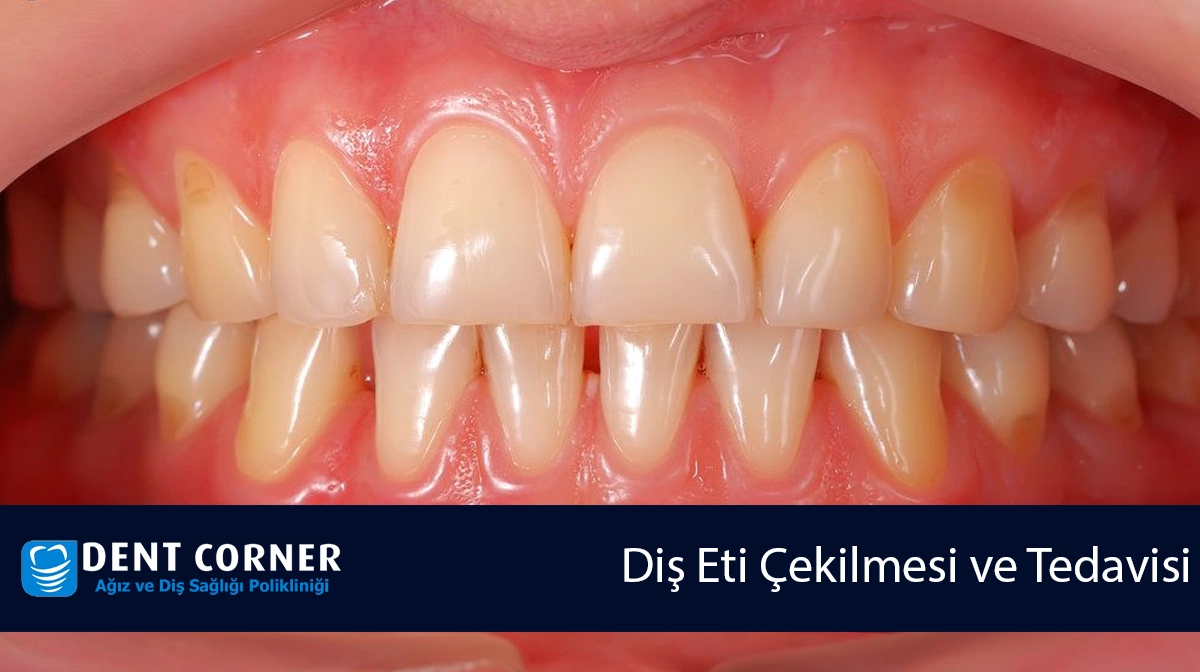 Diş Eti Çekilmesi ve Tedavisi