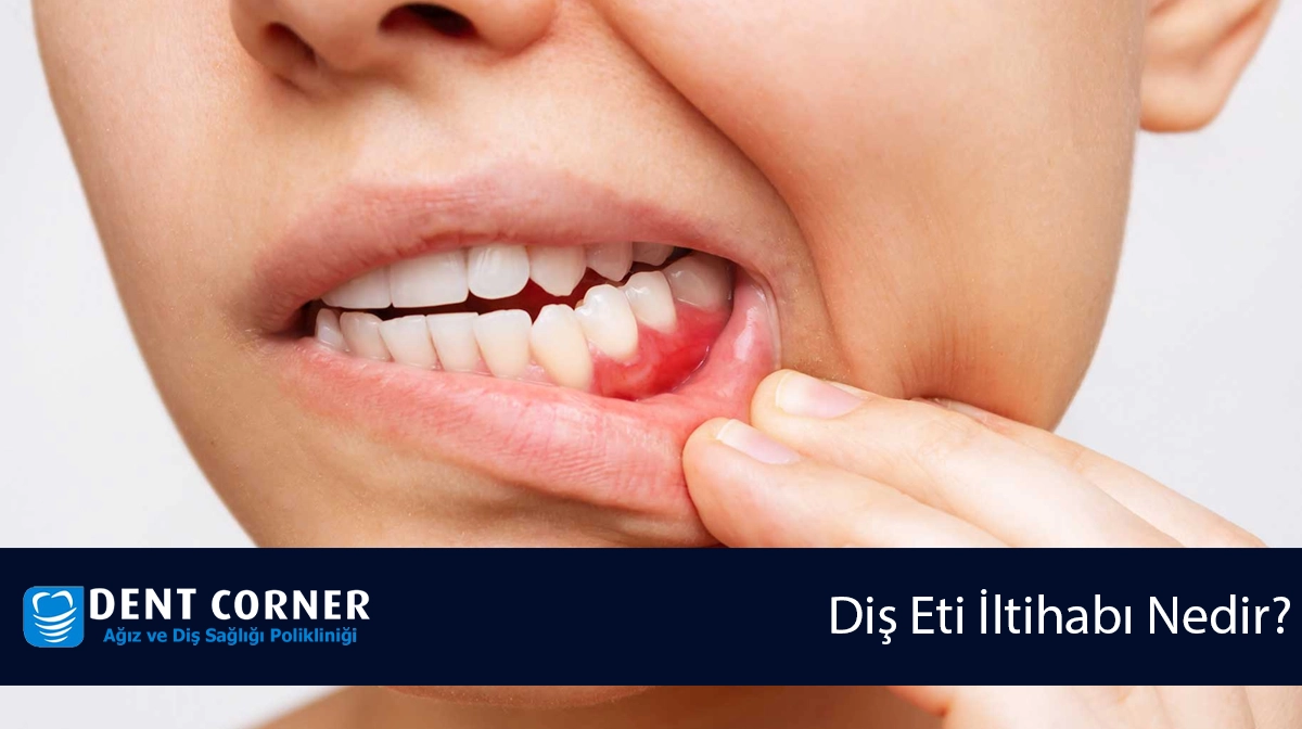 Diş Eti İltihabı Nedir? Diş Eti İltihabına Ne İyi Gelir?