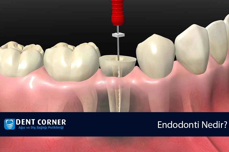 Endodonti Nedir?