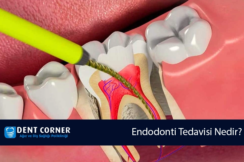 Endodonti (Kanal tedavisi) Nasıl Yapılır?