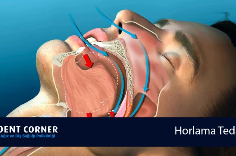 Diş Hekimliğinde Horlama Tedavisi – Horlama Apareyi, Uyku Apnesi