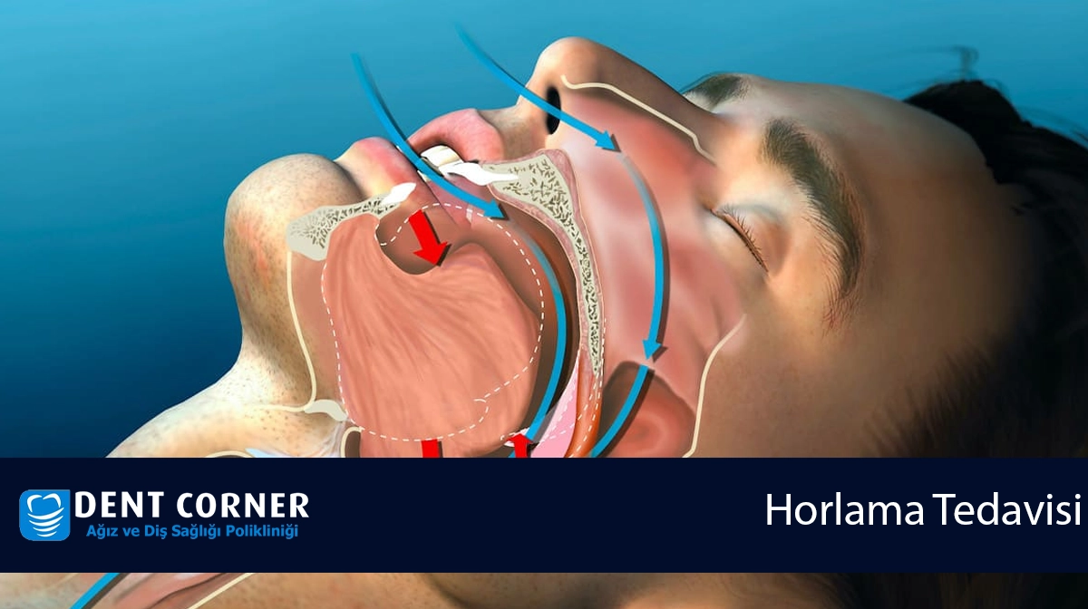 Diş Hekimliğinde Horlama Tedavisi – Horlama Apareyi, Uyku Apnesi