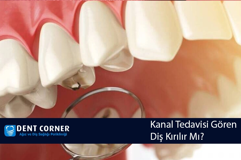 Kanal Tedavisi Gören Diş Kırılır Mı?