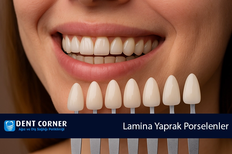 Lamina Yaprak Porselenler