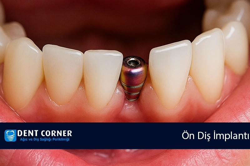 Ön Dişe İmplant Olur Mu?