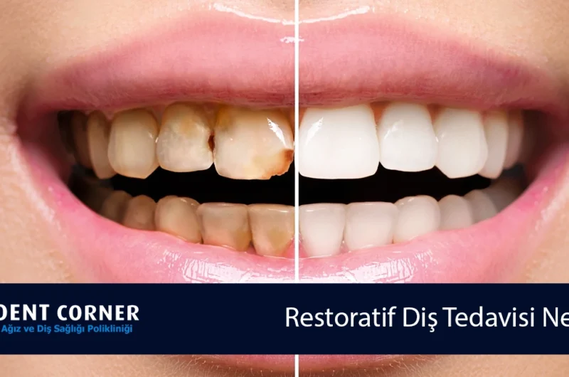 Restoratif Diş Tedavisi Nedir? Nasıl Yapılır?