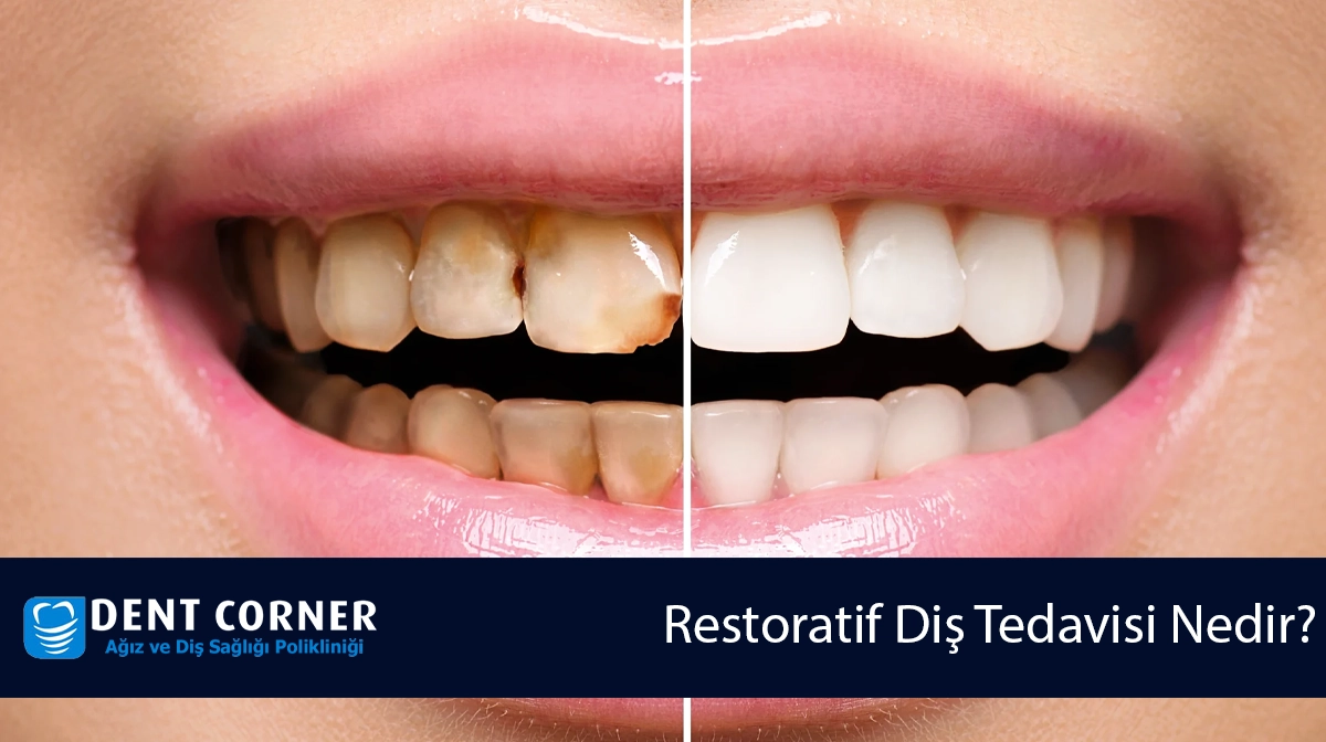 Restoratif Diş Tedavisi Nedir? Nasıl Yapılır?