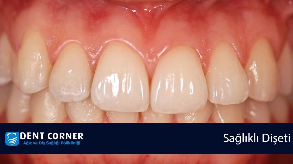 Sağlıklı dişeti nasıl olmalı? (Diş ve Dişeti Hastalıkları)