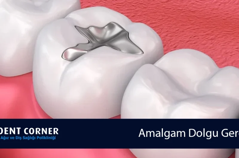 Amalgam Dolgu Gerçeği