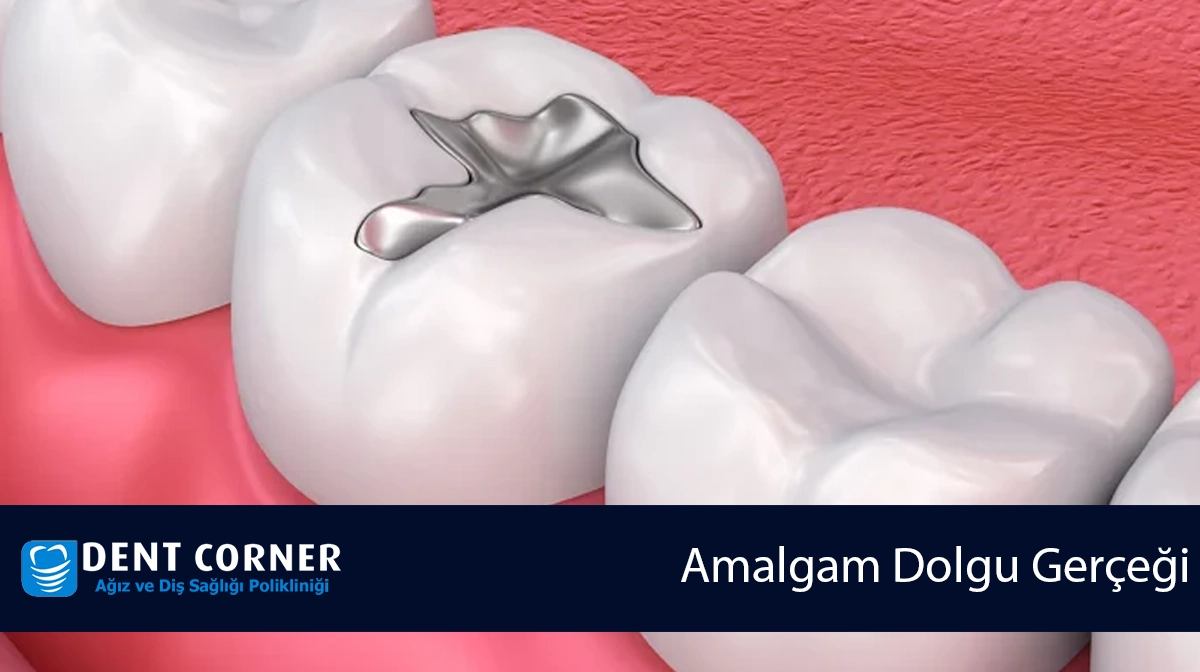 Amalgam Dolgu Gerçeği