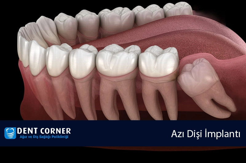 ÇEKİLEN AZI DİŞ YERİNE YENİ DİŞ ÇIKAR MI ?