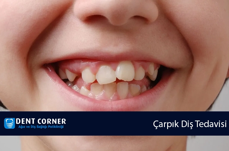 Çarpık Dişler Nasıl Düzeltilir?