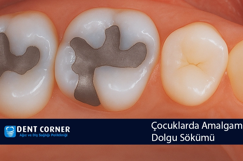 Çocuklarda Amalgam Dolgu Sökümü
