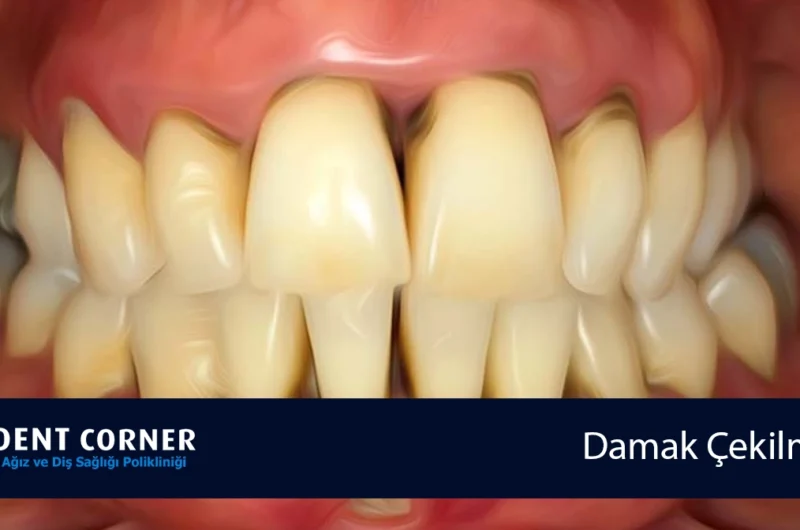 DAMAK ÇEKİLMESİ İÇİN NE YAPMALIYIZ?