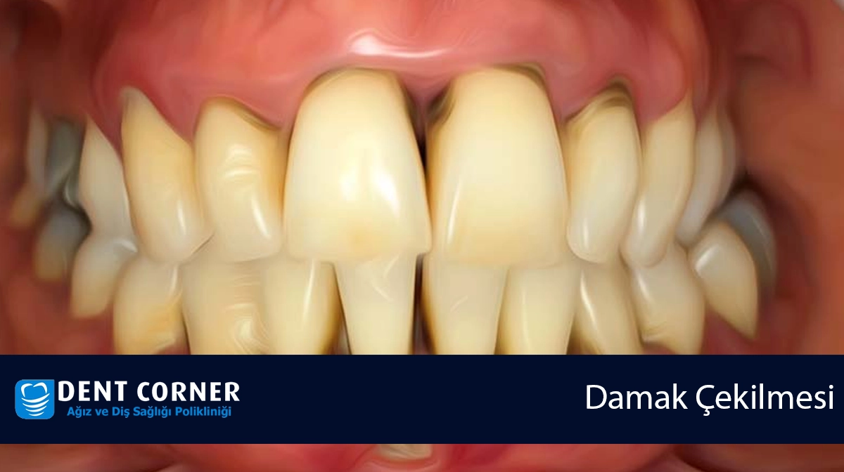 DAMAK ÇEKİLMESİ İÇİN NE YAPMALIYIZ?