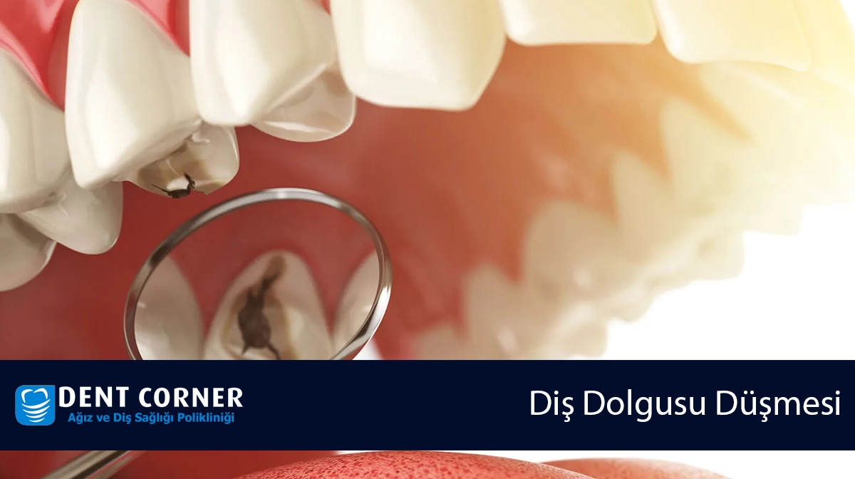 DİŞ DOLGUSU DÜŞMESİ SONUCU OLUŞAN YOĞUN AĞRI