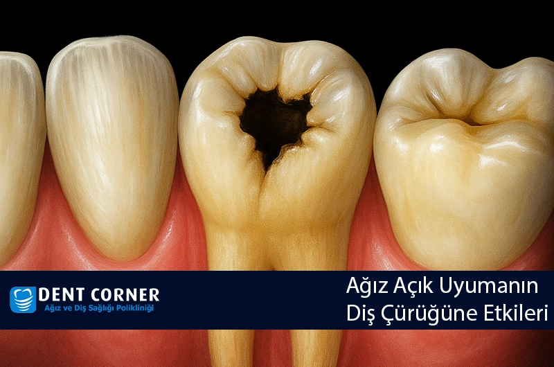 Ağız Açık Uyumanın Diş Çürüğüne Etkileri