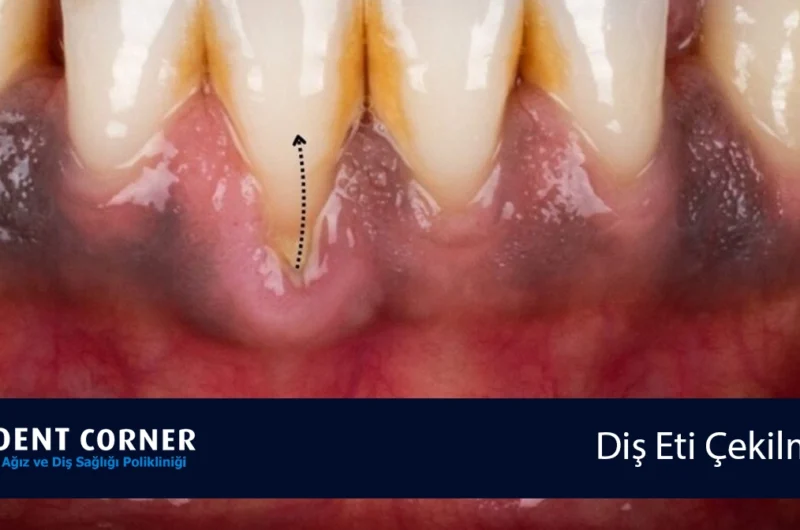 Diş Eti Çekilmesi (Periodontitis) Belirtileri Nelerdir? Diş Eti Çekilmesine Ne İyi Gelir?