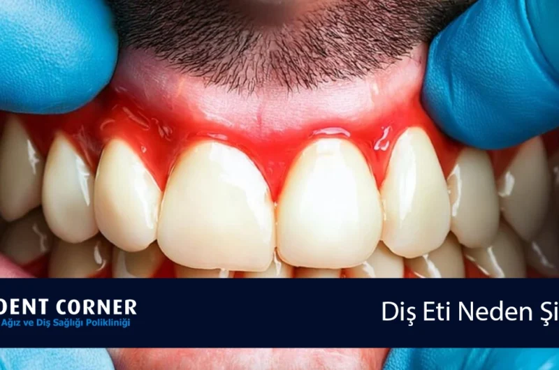 Diş Eti Neden Şişer? Diş Eti Şişmesi Hastalık Belirtisi Midir?