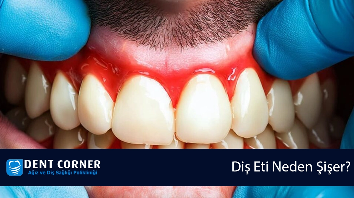 Diş Eti Neden Şişer? Diş Eti Şişmesi Hastalık Belirtisi Midir?