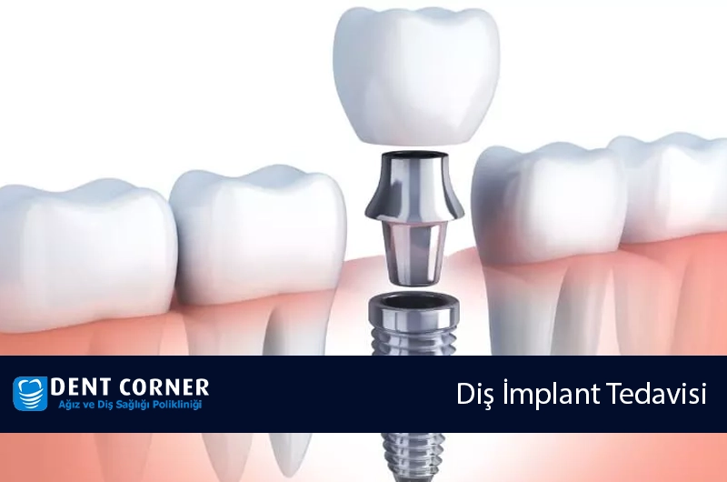 İmplant Nedir? Hangi Durumlarda Uygulanır?