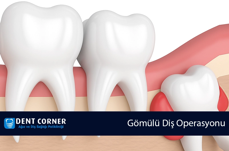 Gömülü Diş Operasyonu Uzun Sürer Mi? Nasıl Bir Operasyondur?
