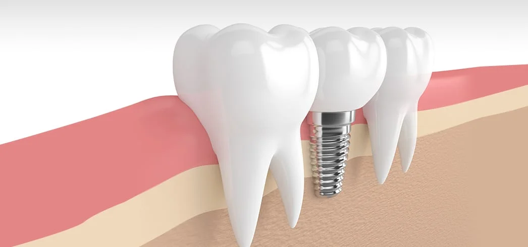 İmplant nedir? Dental implant görseli